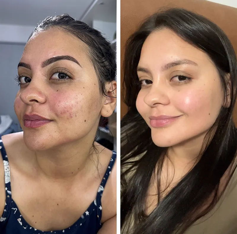 Antes e depois 1 — Clareador Dérmico
