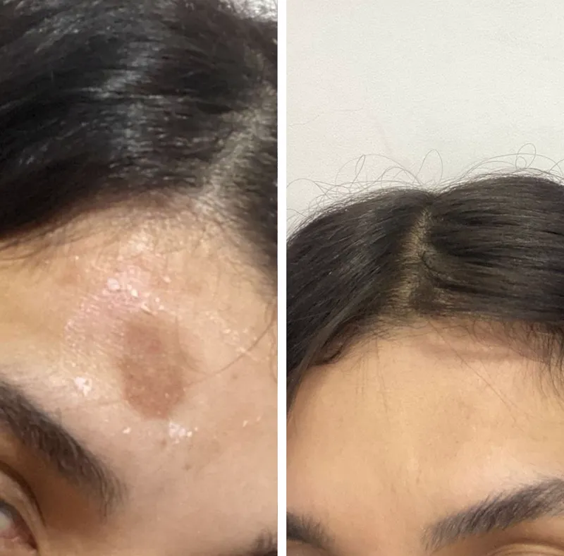 Antes e depois 2 — Clareador Dérmico