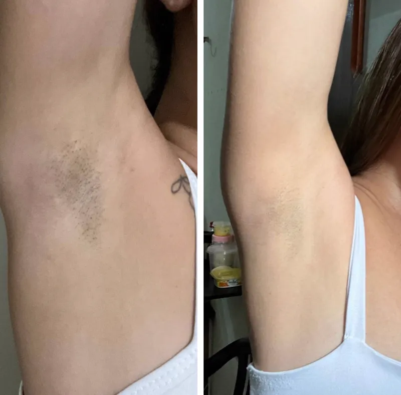 Antes e depois 3 — Clareador Dérmico